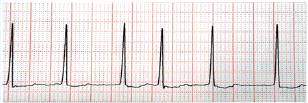 Hyponatremia Treatment Case Study