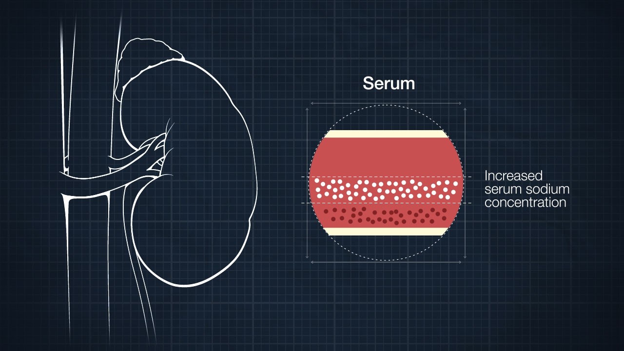 Increased Serum Sodium And Urine Osmolality